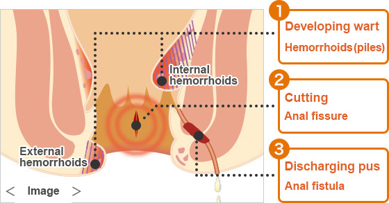 Hemorrhoids are roughly categorized into 3 types.